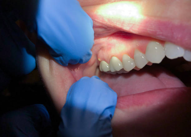 Best Emergency Root Canal Therapy in Itasca, TX