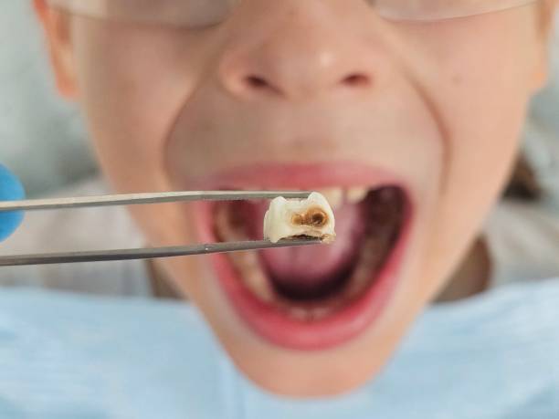 Best Walk-In Emergency Dental Services in Itasca, TX